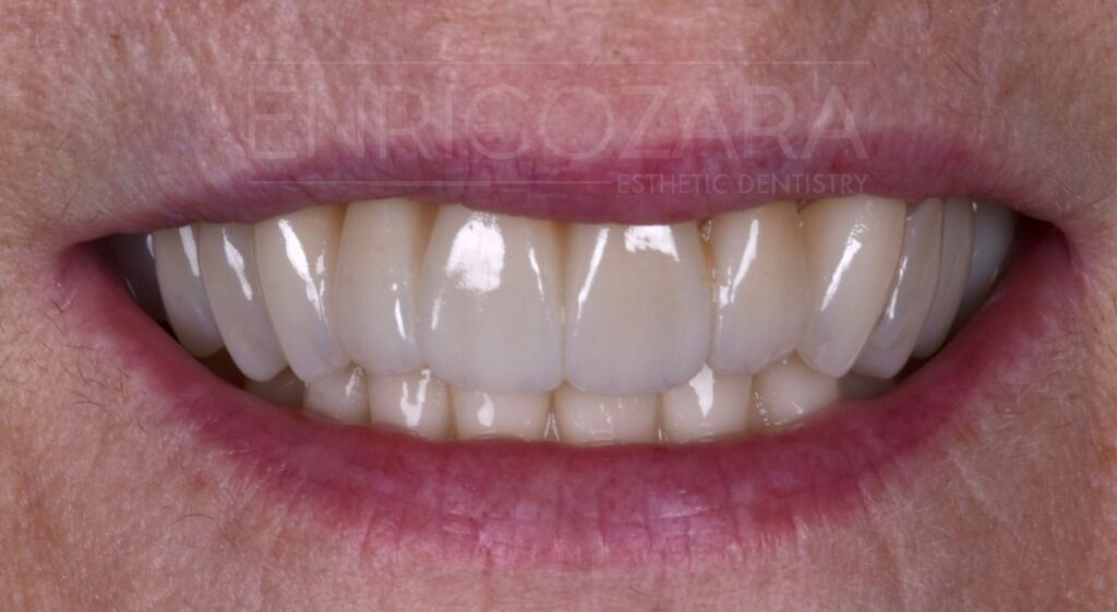 caso studio 1 dopo enrico zara estetica dentale