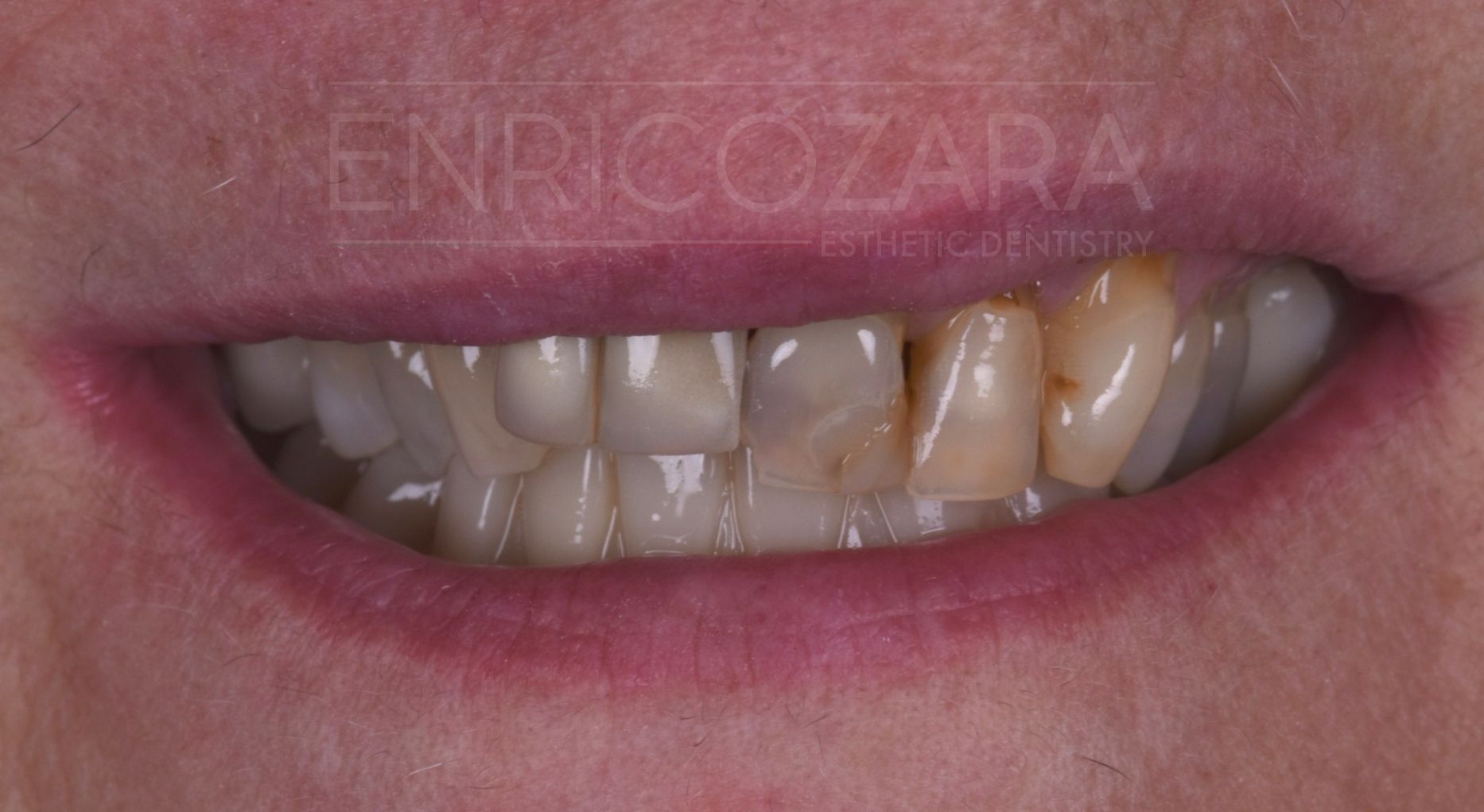 caso studio 1 prima enrico zara estetica dentale