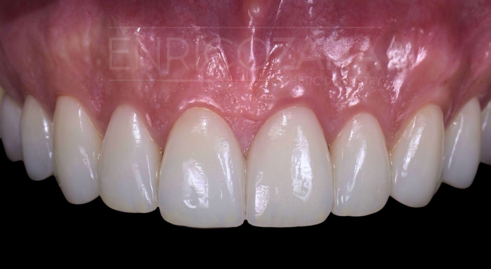 caso studio 2 dopo enrico zara estetica dentale