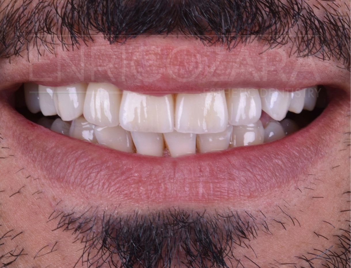 caso studio faccette sardegna dr zara