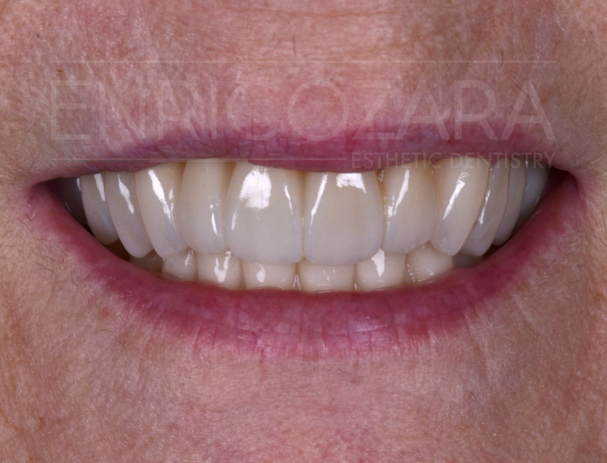 giovanna faccette estetiche enrico zara - dopo