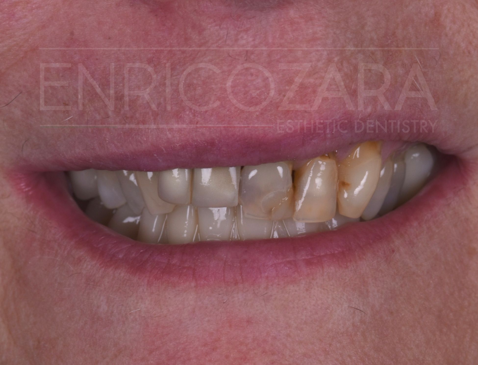 giovanna faccette estetiche enrico zara - prima