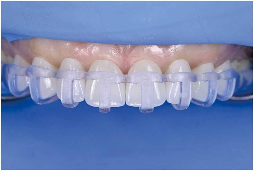 Dima per Faccette dentali