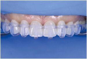 Dima per Faccette dentali