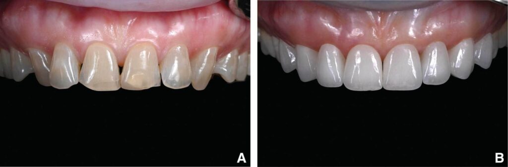 Dr. Enrico Zara - Faccette dentali cementate con la dima